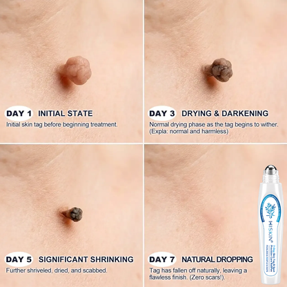𝐇𝐈𝐒𝐊𝐈𝐍®👩‍⚕️ 𝟕-𝐃𝒂𝘆 𝐒𝗸𝐢𝐧 𝐓𝒂𝗴 & 𝐒𝐩𝙤𝐭 𝐄𝐫𝒂𝐬𝙚𝐫 Painless & Scar-Free Advanced Imperfection Removal Rollerball Pen✨✨
